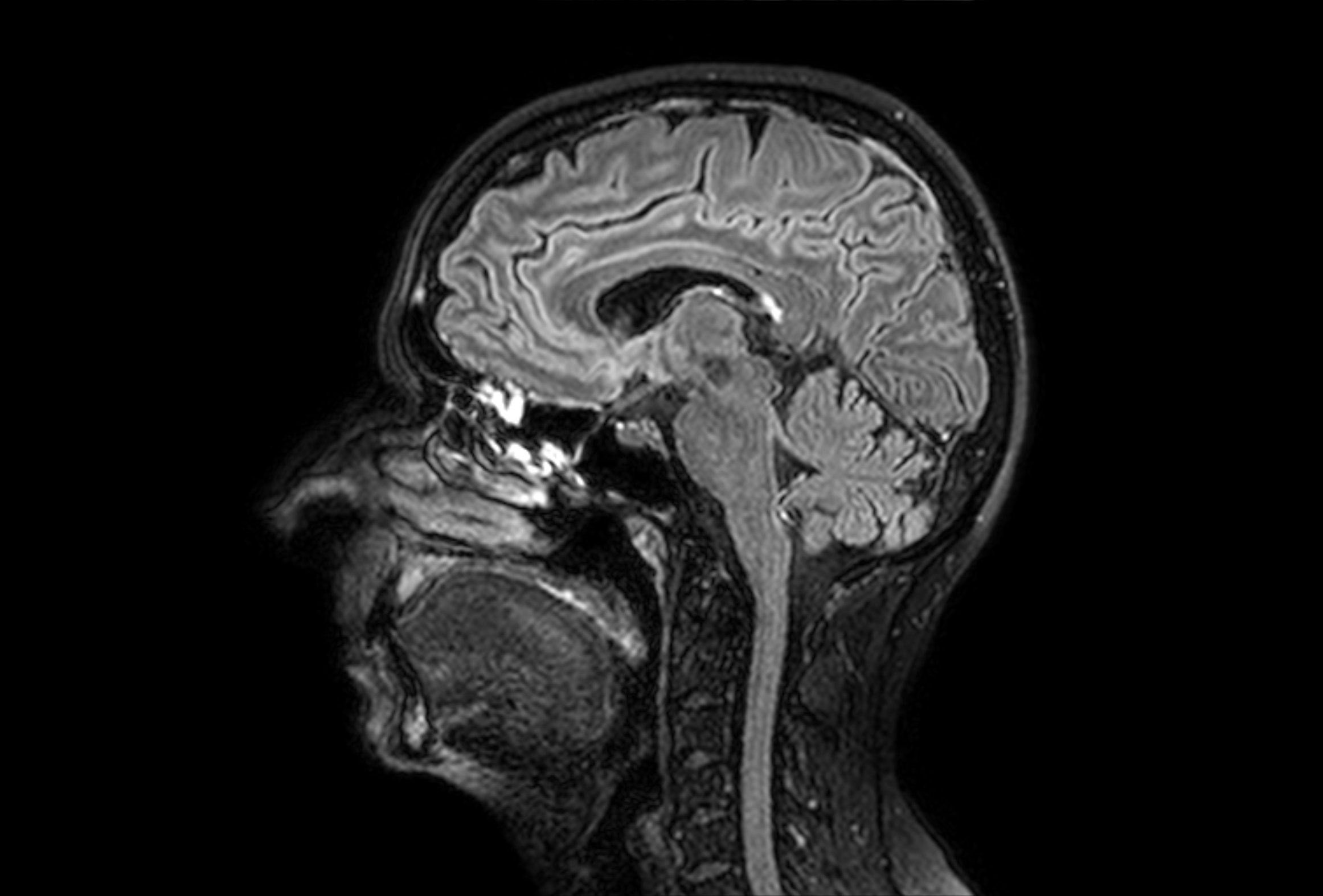 Bild MRT Gehirn