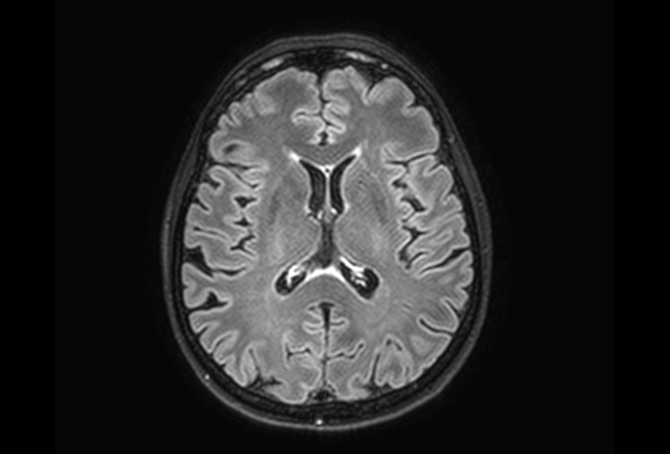 Bild MRT Gehirn oben